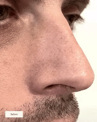 Norillo™ – Djupverkande Näspatch för Klarare Hud